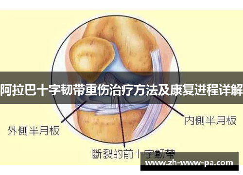 阿拉巴十字韧带重伤治疗方法及康复进程详解